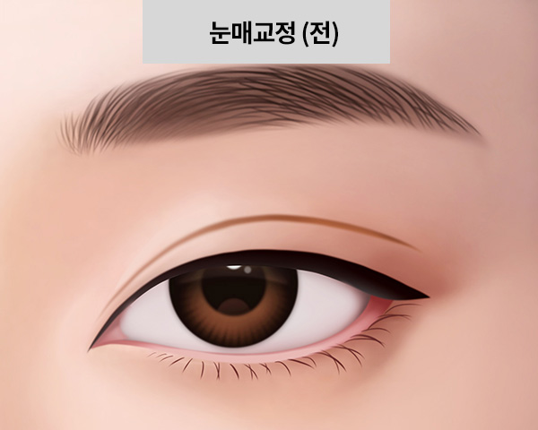 눈매교정 정