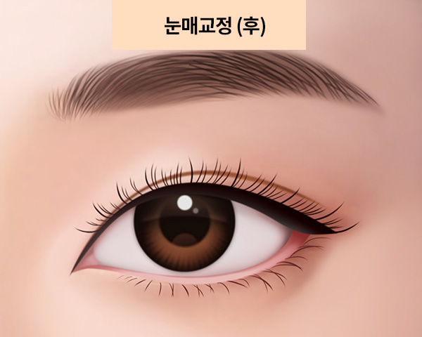 눈매 교정 후