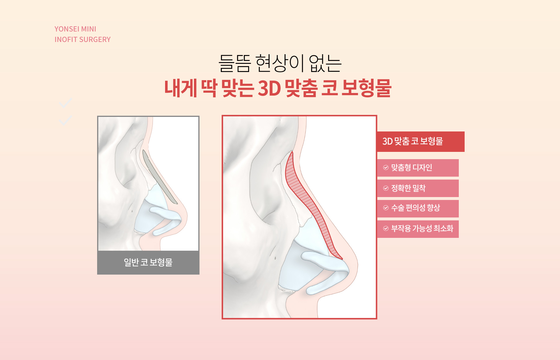 들뜸 현상이 없는 내게 딱 맞는 3D 맞춤 코 보형물