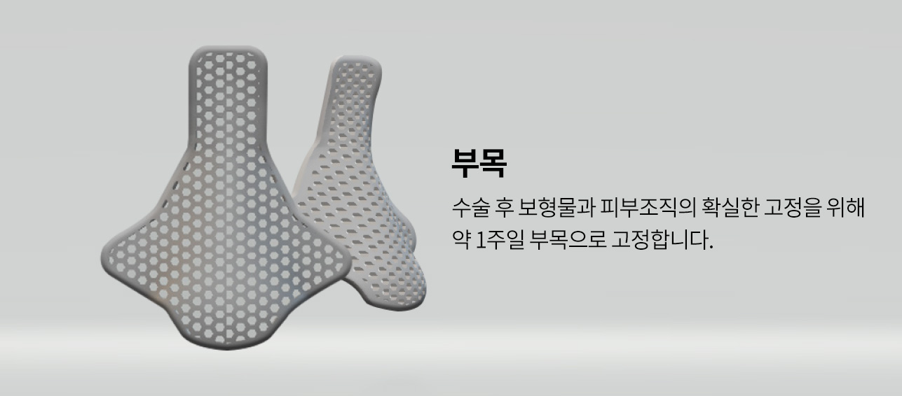 부목 수술 후 보형물과 피부조직의 확실한 고정을 위해 약 1주일 부목으로 고정합니다.
