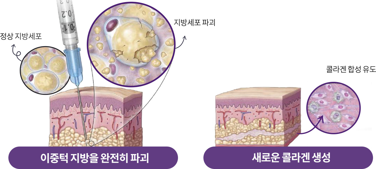 이중턱 지방을 완전히 파괴, 새로운 콜라겐 생성