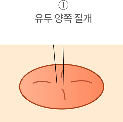 1. 유두 양쪽 절개