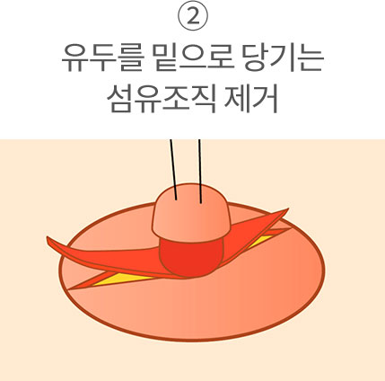 2. 유두를 밑으로 당기는 섬유조직 제거