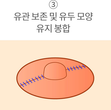 3. 유관 보존 및 유두 모양 유지 봉합